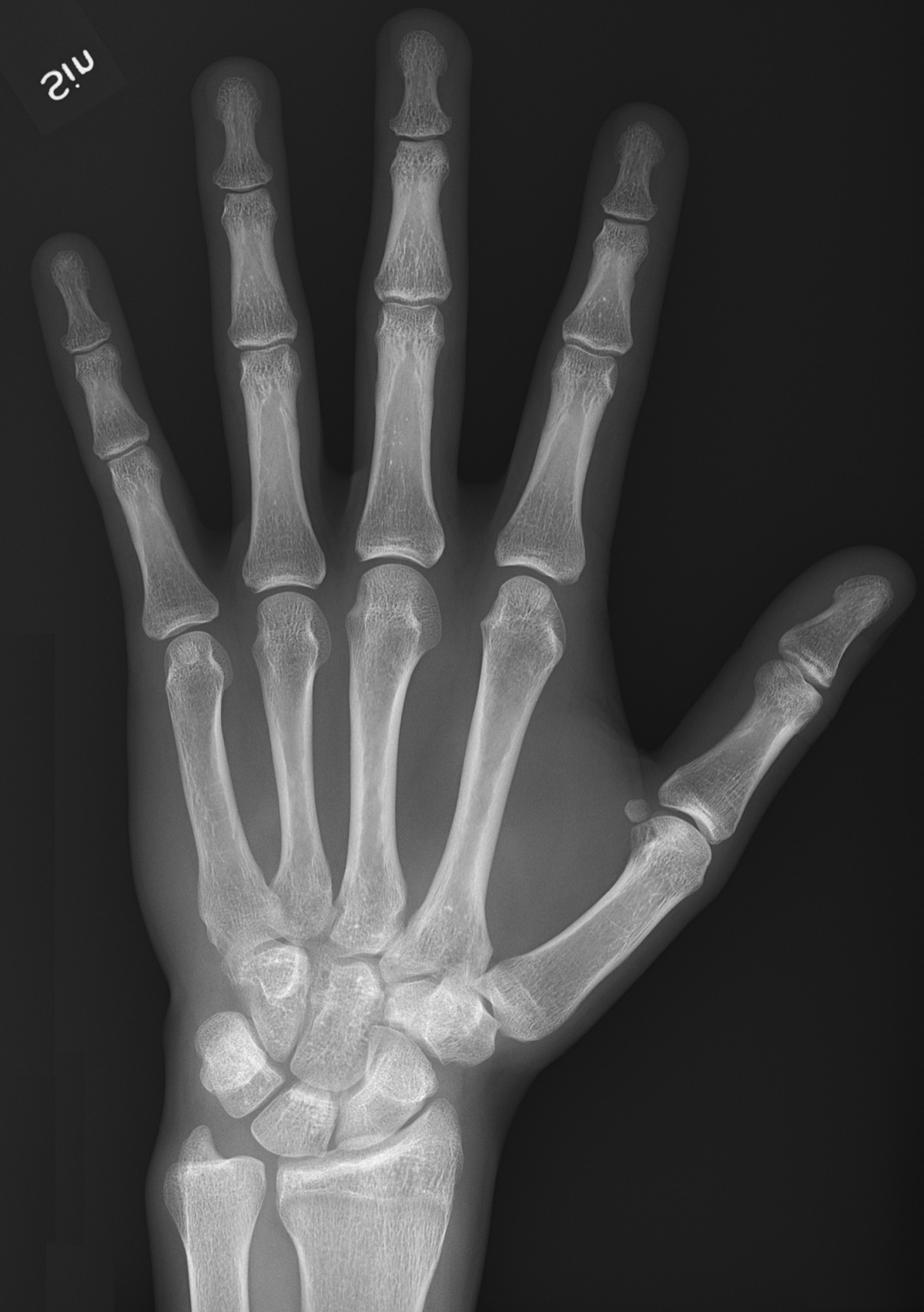 X-ray of a healthy human hand showing the finger bones and joints - the kind of skeletal and joint structures that mice regrew in the Texas A&M FGF2/BMP2 regeneration study